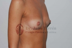 Fotos antes y despues de mamoplastia aumento de seno