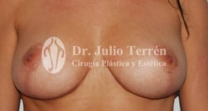 Mastopexia Valencia Dr. Terrén
