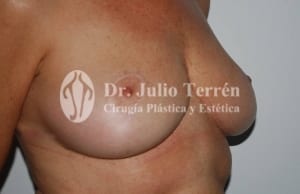 Cirugia reducción de pecho Dr. Terren despues