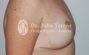 Breast reduction Before & after photos Valencia Dr. Terrén