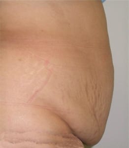 Fotos abdominoplastia antes y despues Dr. terrén Valencia