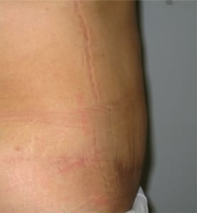 Fotos abdominoplastia antes y despues Dr. terrén