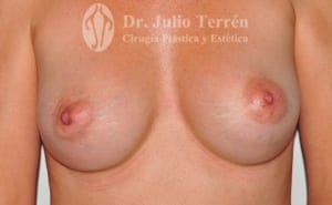 Fotos Pechos tuberosos antes y despues Valencia Dr. Terrén