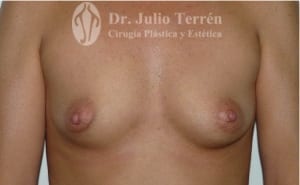 Photos TUBEROUS BREAST before in Valencia Dr. Terren