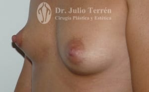 Fotos mamas tuberosas antes y despues Dr. Terrén