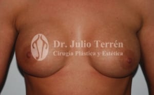 Caida de implantes mamarios Valencia