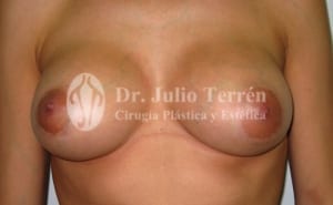 Cambio forma y/o tamaño protesis senos Dr. Terrén