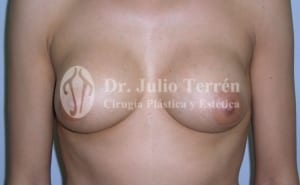 Cambio forma o tamaño protesis de pecho Dr. Terrén