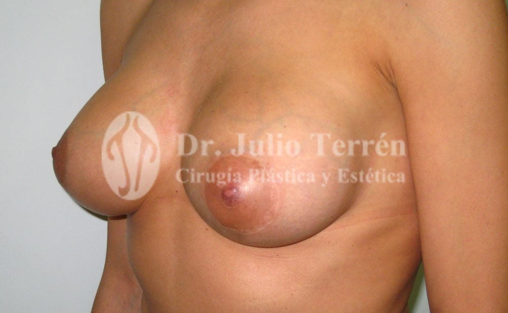 sustitución implantes mamarios Valencia Dr. Terrén