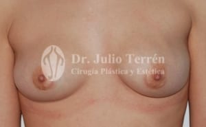 Cambios en implantes de pecho Dr. Terrén Valencia