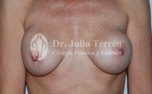 segundo aumento de pecho por Encapsulamiento protesis Dr. Terrén