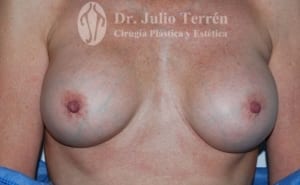 CAPSULAR CONTRACTURE case 2 AFTER