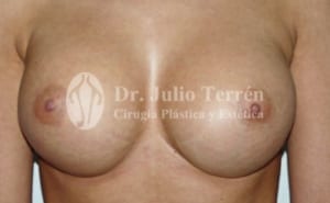 DISPLACEMENT OF BREAST IMPLANTS Dr Terrén