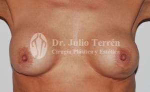 DISPLACEMENT OF BREAST IMPLANTS Case 3 Before