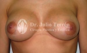 BREAST IMPLANTS RUPTURE Dr. Terren in Valencia