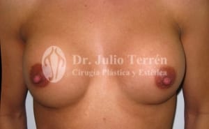 BREAST IMPLANTS RUPTURE Dr. Terrén