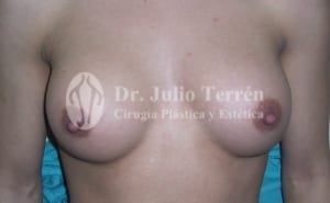 BREAST IMPLANTS RUPTURE Valencia Dr. Terrén