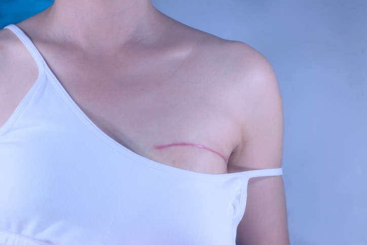 Cirugía reconstructoiva de mamas tras mastectomía