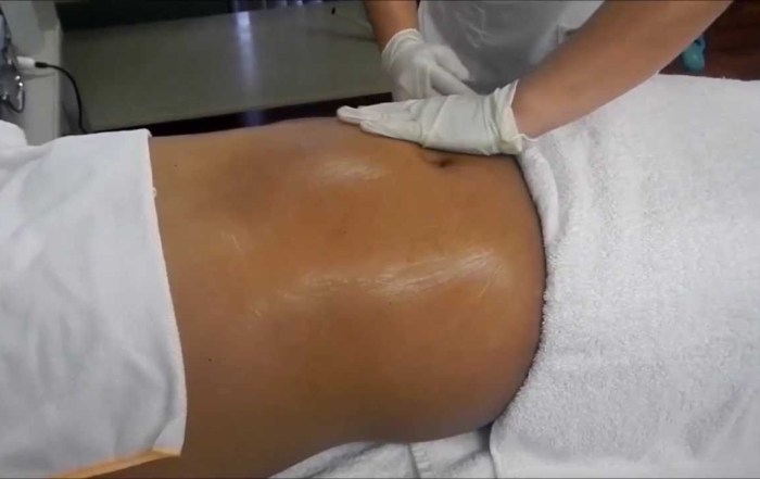 Drenaje linfático post operatorio abdominoplastia y liposuccion en Valencia Dr.terrén