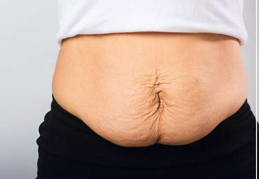 Abdominoplastia después del embarazo: elimina estrías y distensión muscular 