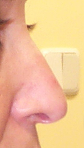 punta de nariz después de la cirugía